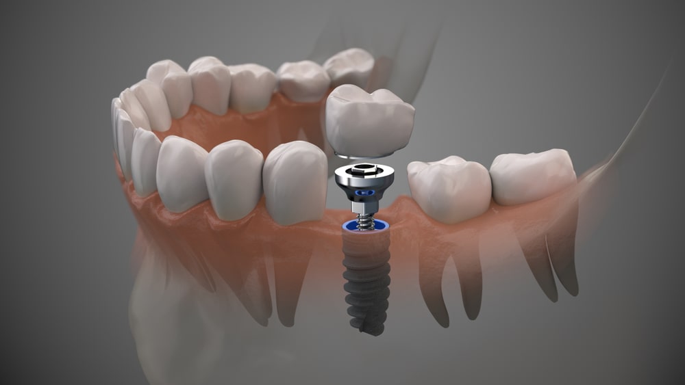 L’implant dentaire